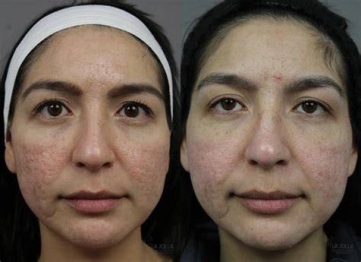 acne scars before and after