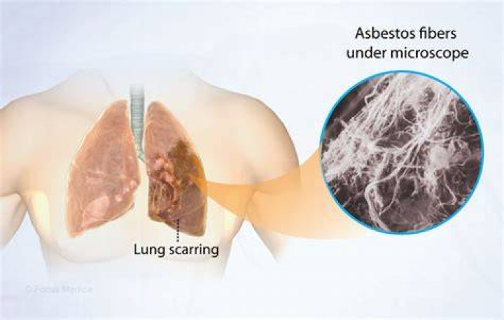 Asbestosis - How To Discuss