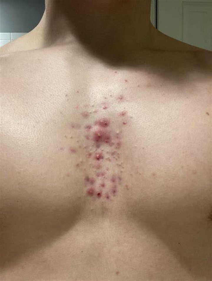 chest and back acne