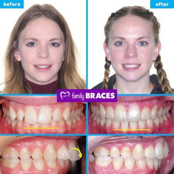 Do You Pay For Braces Up Front