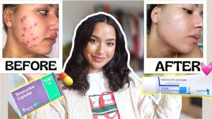 doxycycline for acne