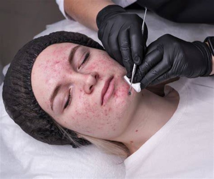 facials for blackheads