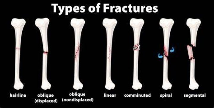 Hairline Fracture - How To Discuss