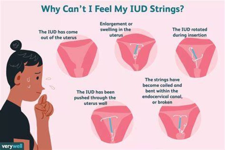 I Can T Feel My Iud Strings Anymore