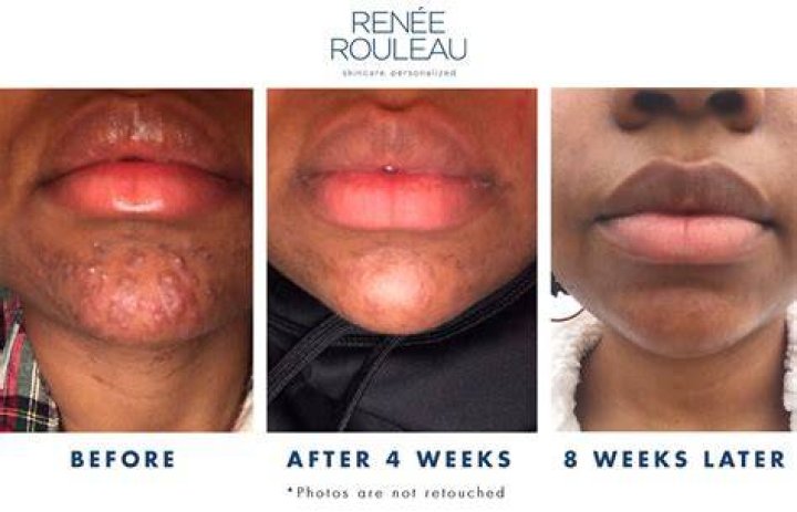 iud acne