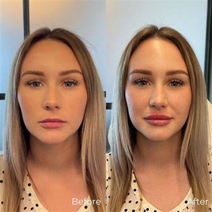 lip fillers before and after 1ml