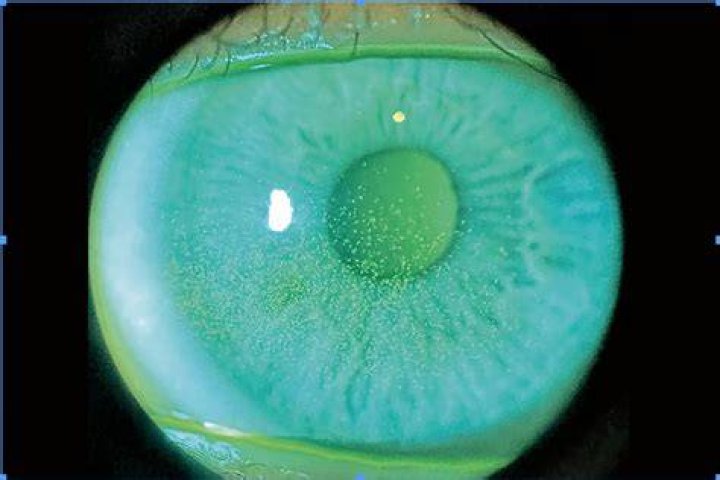 spk eye